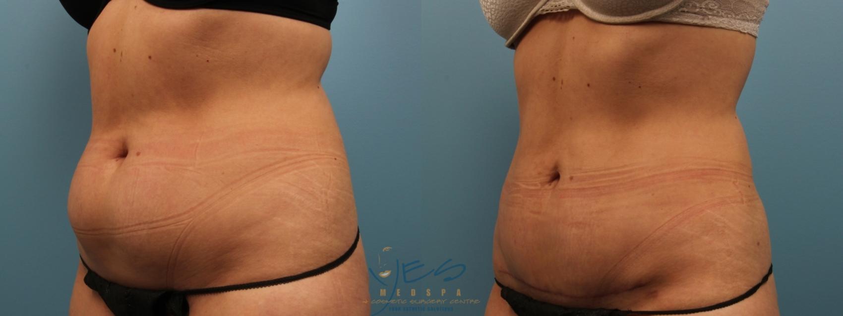 Before & After Tummy Tuck Case 152 Left Oblique View in Vancouver, BC