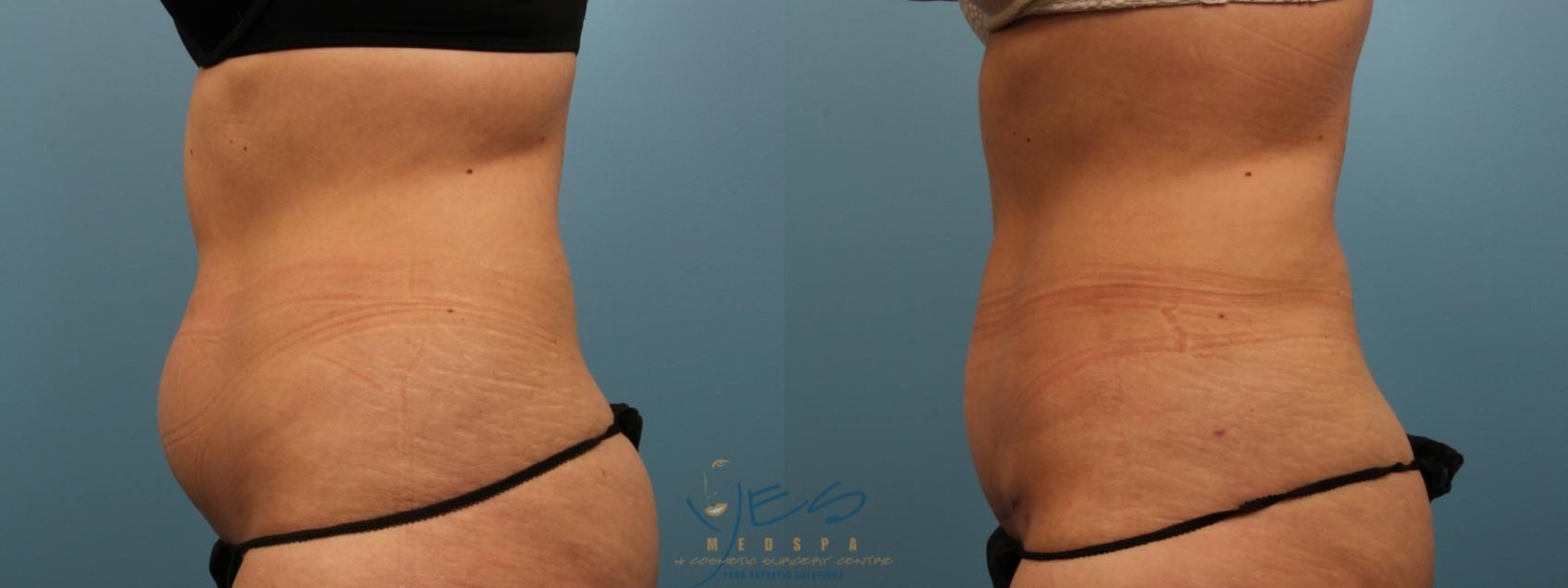 Before & After Tummy Tuck Case 152 Left Side View in Vancouver, BC
