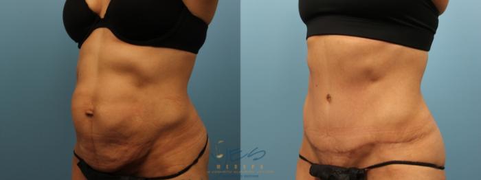 Before & After Tummy Tuck Case 155 Left Oblique View in Vancouver, BC