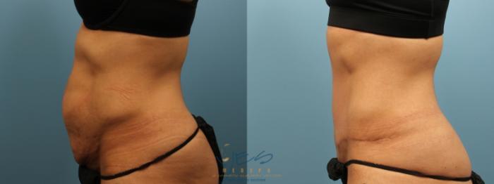 Before & After Tummy Tuck Case 155 Left Side View in Vancouver, BC