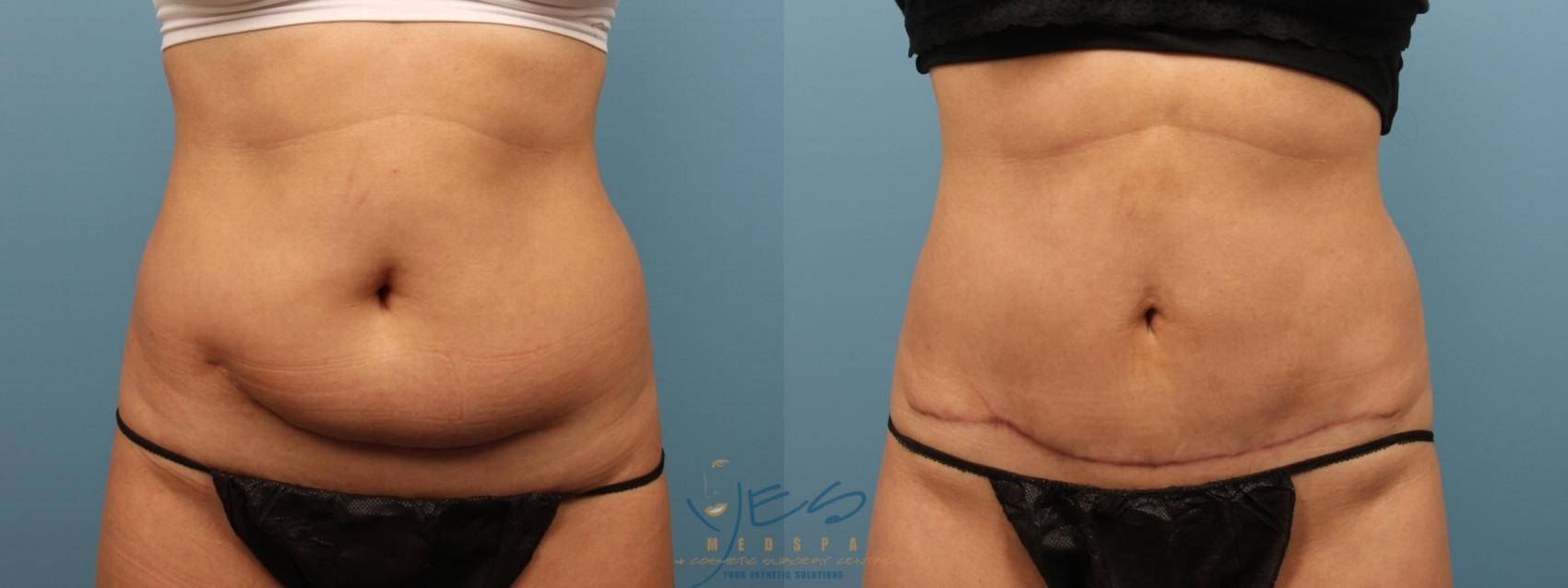 Before & After Tummy Tuck Case 160 Front View in Vancouver, BC
