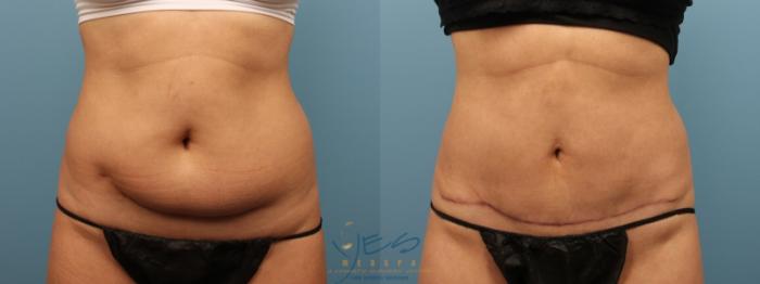 Before & After Tummy Tuck Case 160 Front View in Vancouver, BC