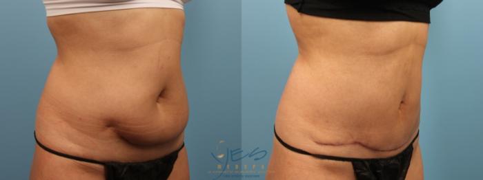 Before & After Liposuction Case 160 Right Oblique View in Vancouver, BC