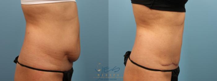 Before & After Tummy Tuck Case 160 Right Side View in Vancouver, BC