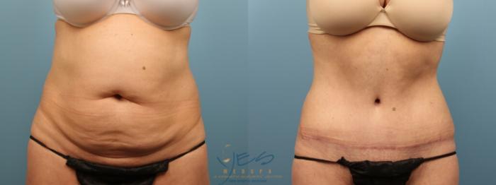 Before & After Tummy Tuck Case 165 Front View in Vancouver, BC