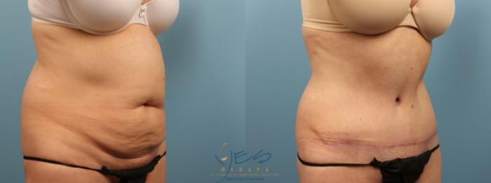 Before & After Tummy Tuck Case 165 Right Oblique View in Vancouver, BC