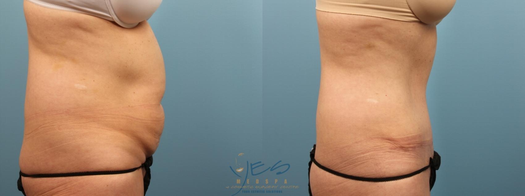 Before & After Tummy Tuck Case 165 Right Side View in Vancouver, BC