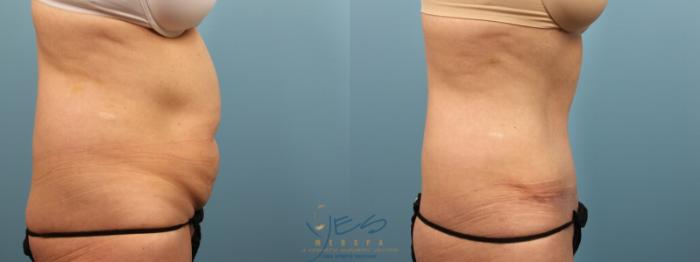 Before & After Tummy Tuck Case 165 Right Side View in Vancouver, BC