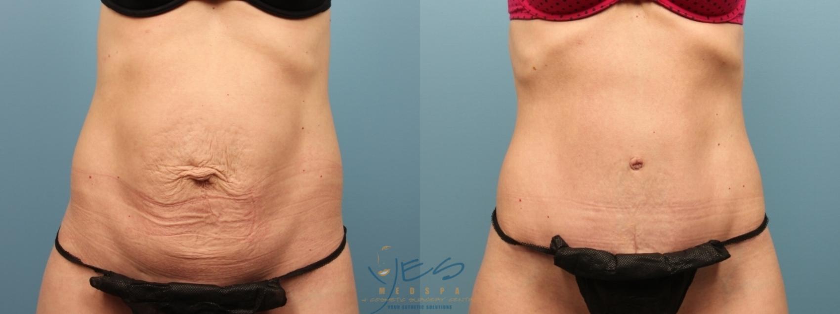 Before & After Tummy Tuck Case 183 Front View in Vancouver, BC
