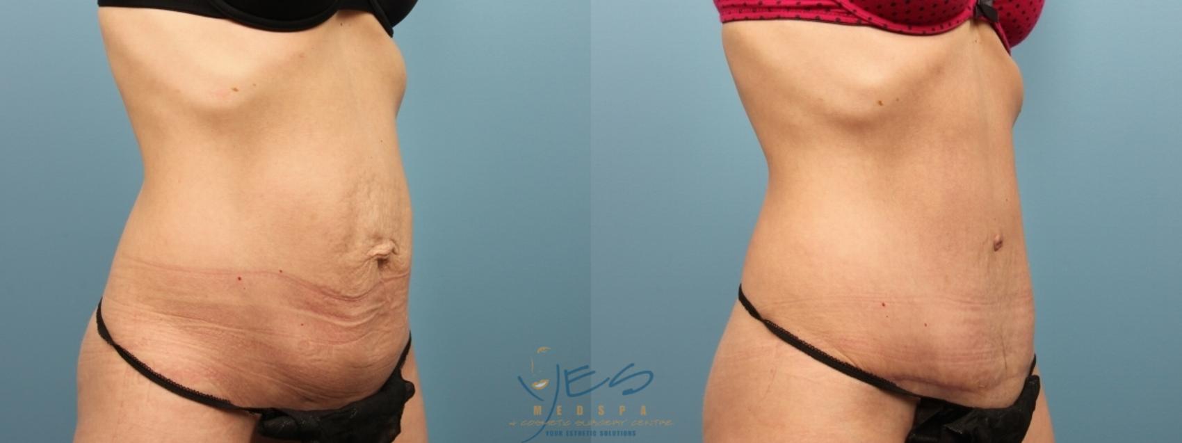 Before & After Tummy Tuck Case 183 Right Oblique View in Vancouver, BC