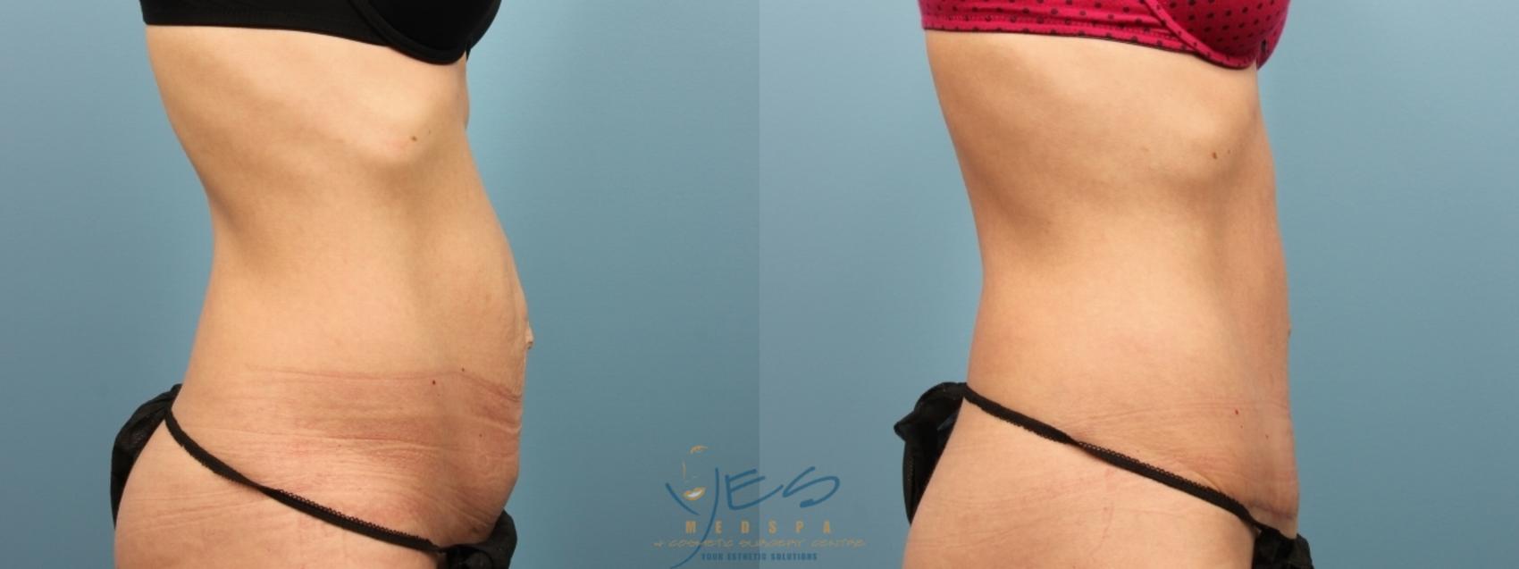 Before & After Tummy Tuck Case 183 Right Side View in Vancouver, BC