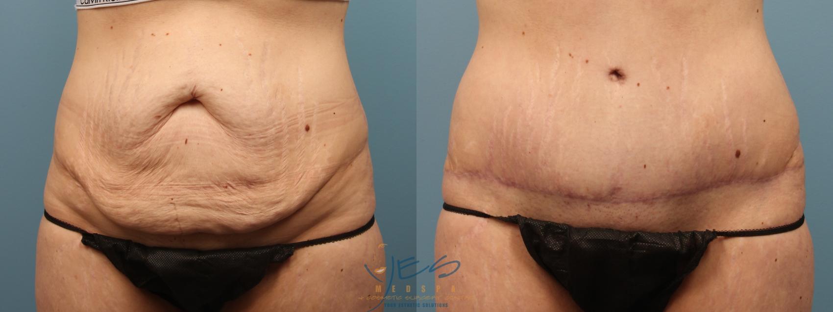 Tummy Tuck in Vancouver, Abdominoplasty