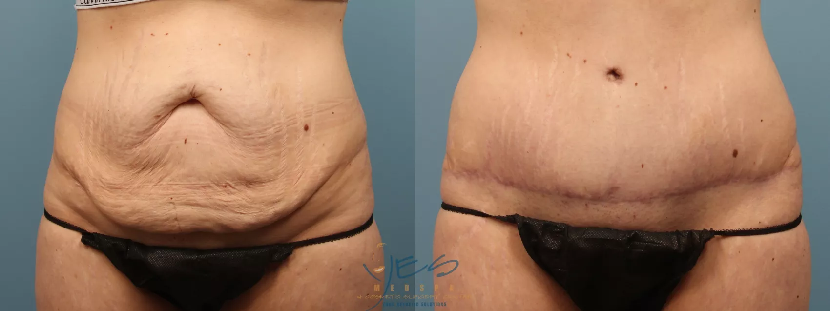 Tummy Tuck Before & After Photos Patient 186, Vancouver, BC