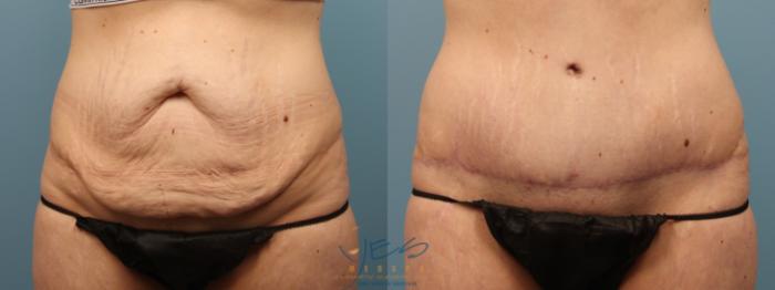 Before & After Tummy Tuck Case 186 Front View in Vancouver, BC