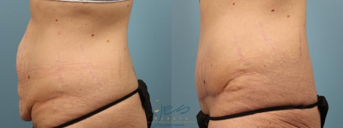 Before & After Tummy Tuck Case 186 Left Side View in Vancouver, BC
