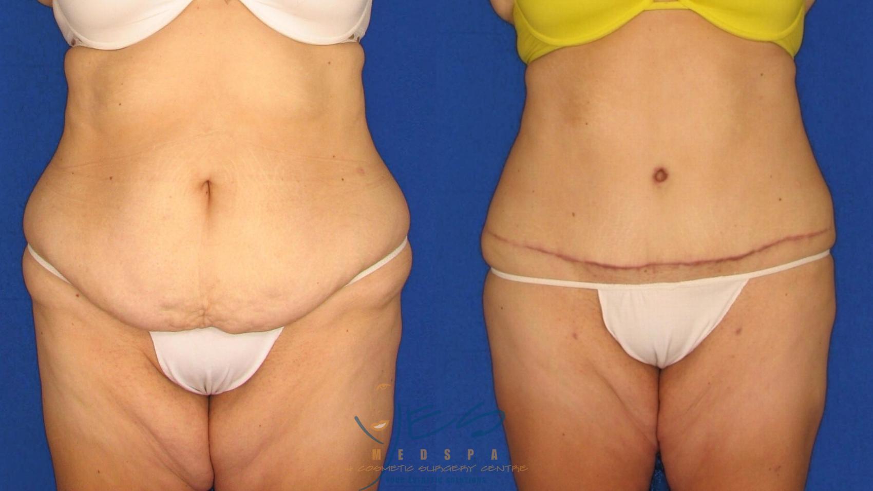 Before & After Tummy Tuck Case 19 Front View in Vancouver, BC