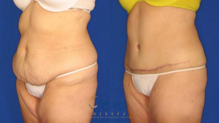 Before & After Tummy Tuck Case 19 Left Oblique View in Vancouver, BC