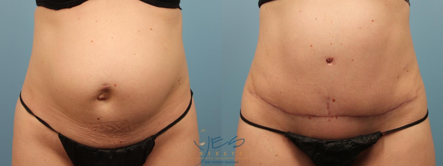 Before & After Tummy Tuck Case 205 Front View in Vancouver, BC