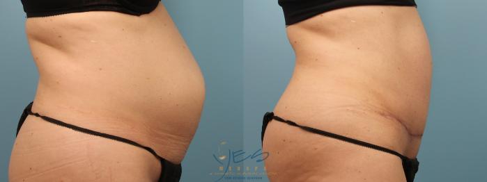 Before & After Tummy Tuck Case 205 Right Side View in Vancouver, BC