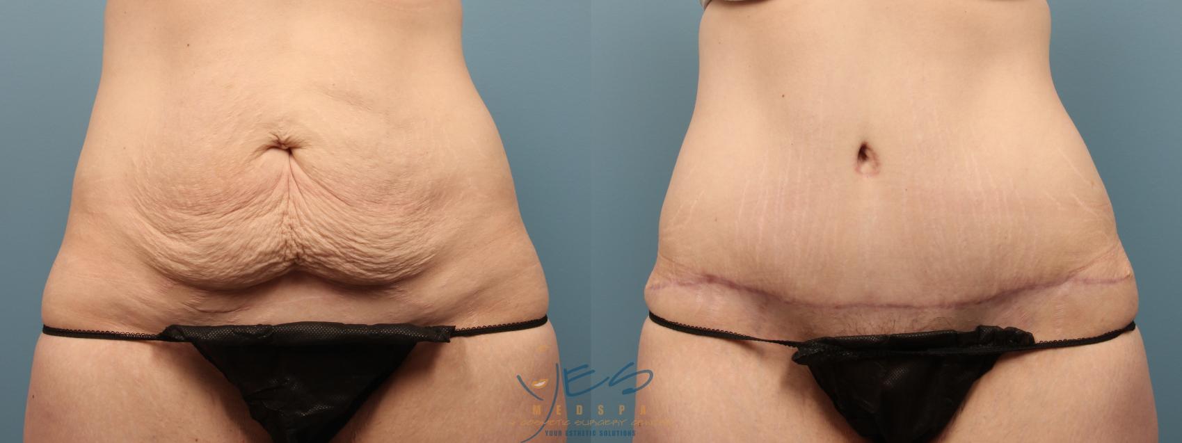Before & After Tummy Tuck Case 206 Front View in Vancouver, BC