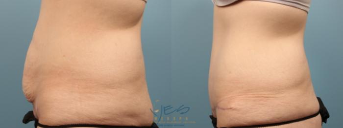 Before & After Tummy Tuck Case 206 Left Side View in Vancouver, BC