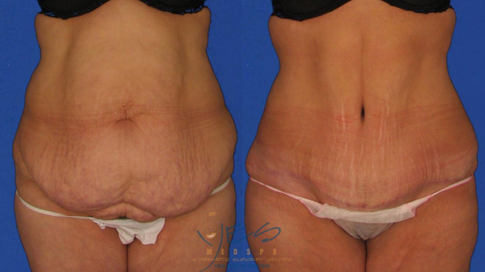 Before & After Tummy Tuck Case 21 Front View in Vancouver, BC