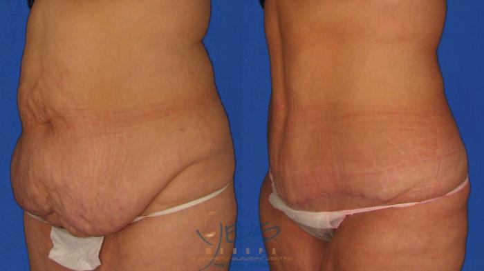 Before & After Tummy Tuck Case 21 Left Oblique View in Vancouver, BC