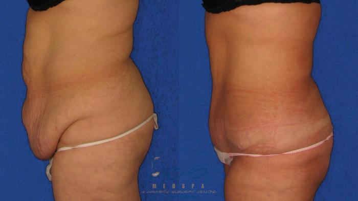 Before & After Tummy Tuck Case 21 Left Side View in Vancouver, BC
