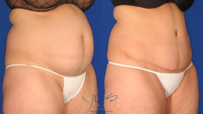 Before & After Tummy Tuck Case 24 Right Oblique View in Vancouver, BC