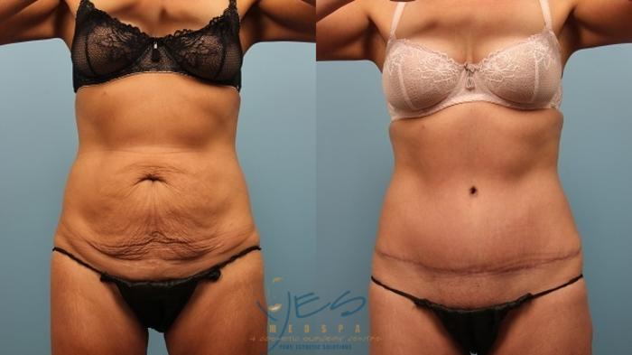 Before & After Tummy Tuck Case 256 Front View in Vancouver, BC