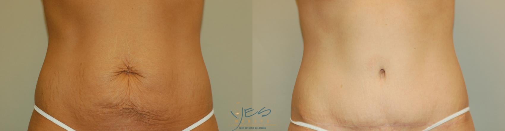 Before & After Tummy Tuck Case 260 Front View in Vancouver, BC