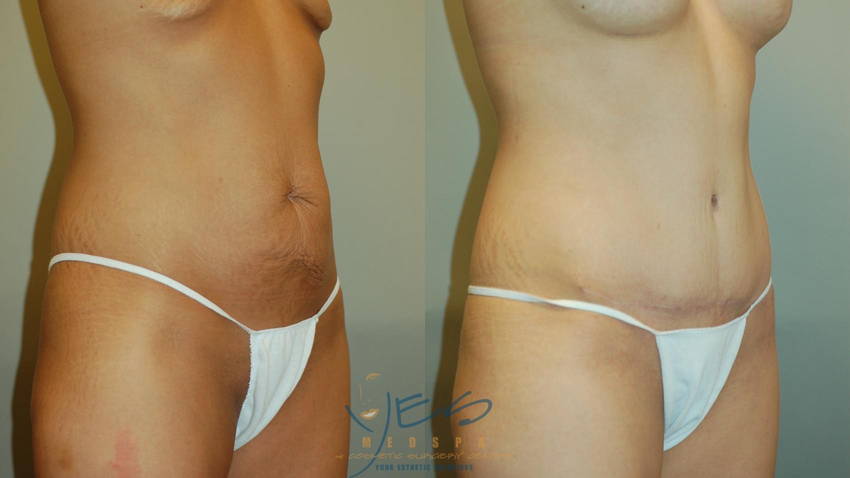 Before & After Tummy Tuck Case 260 Left Oblique View in Vancouver, BC