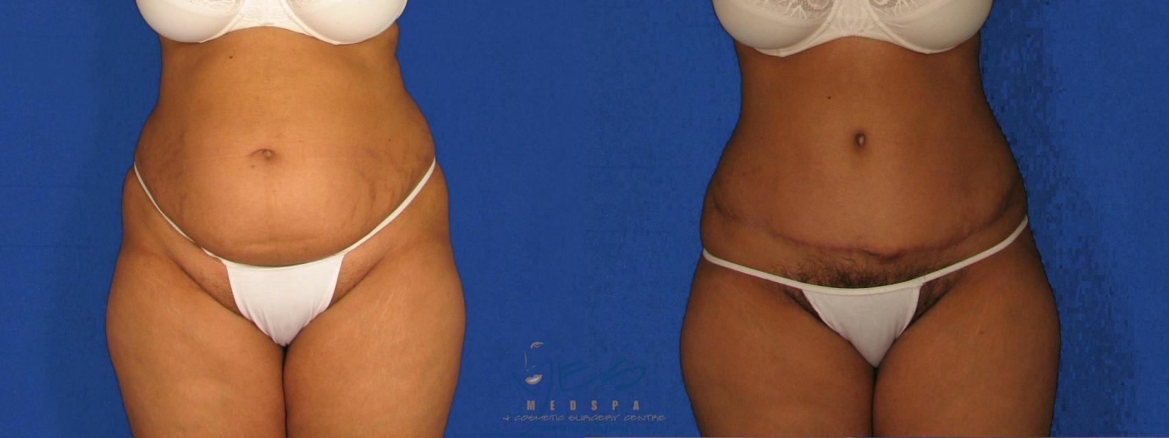 Before & After Tummy Tuck Case 267 Front View in Vancouver, BC