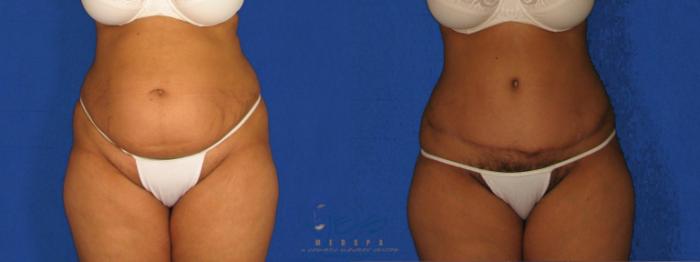 Before & After Tummy Tuck Case 267 Front View in Vancouver, BC