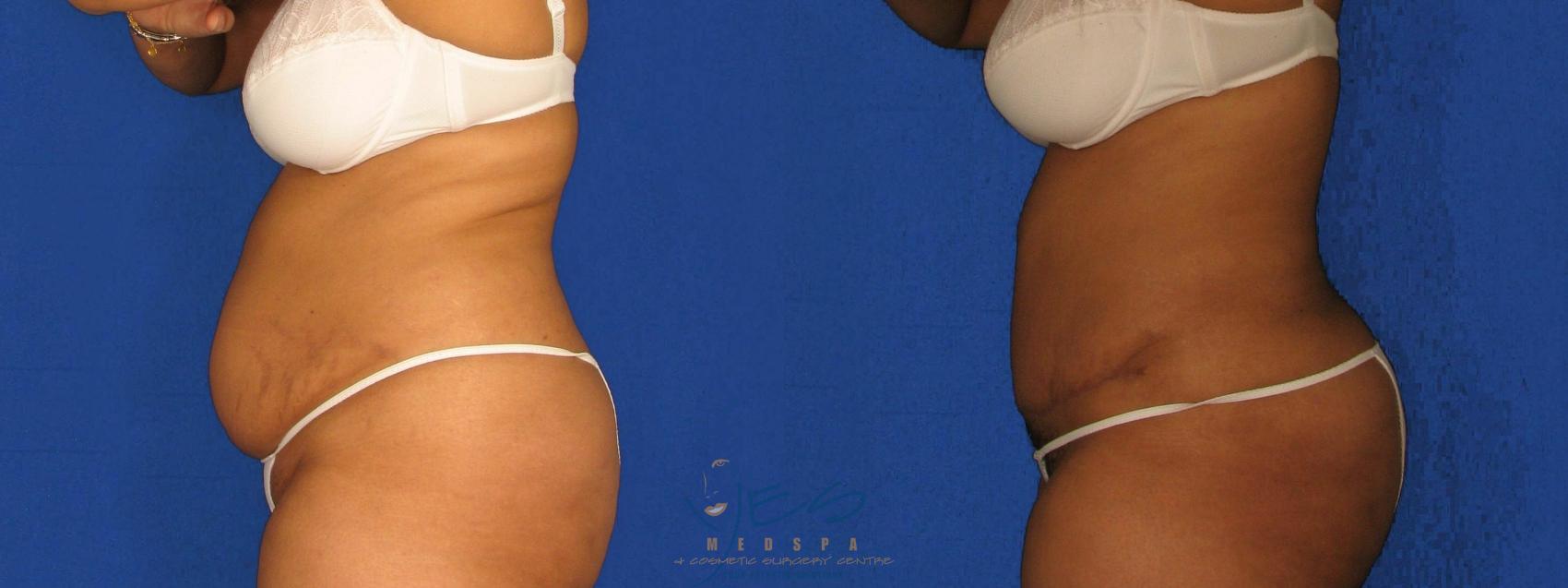 Before & After Tummy Tuck Case 267 Left Side View in Vancouver, BC