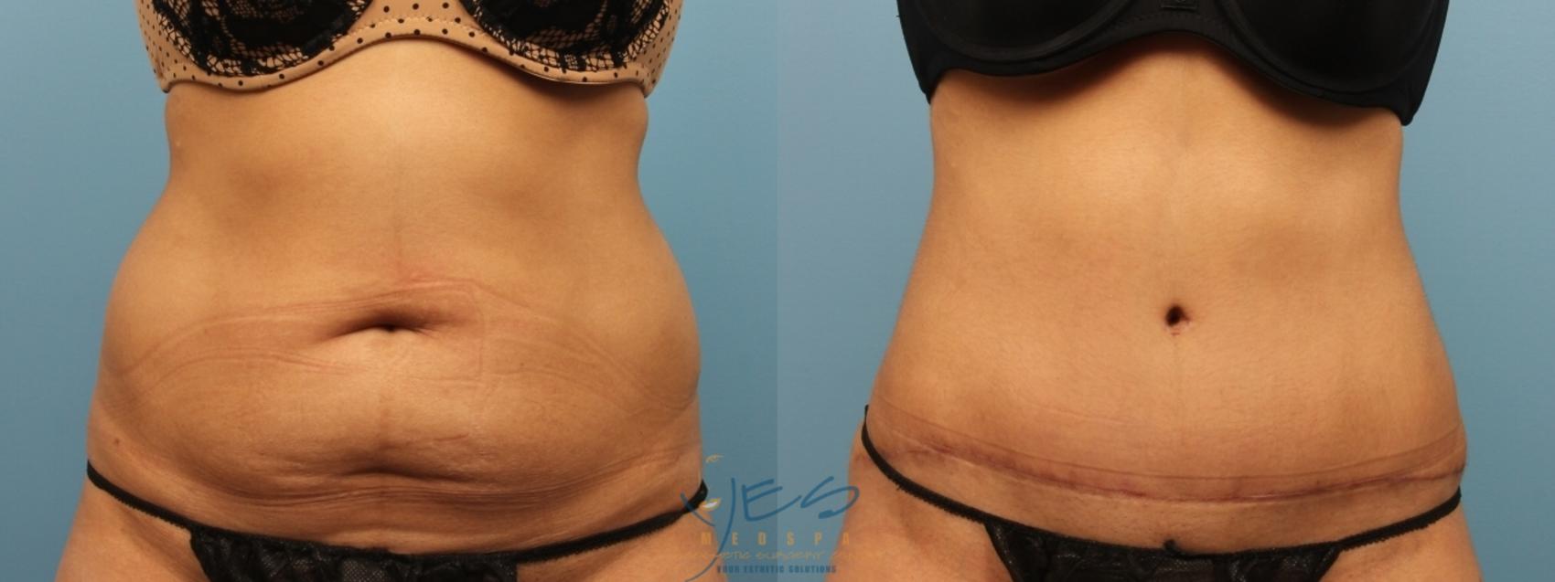 Before & After Tummy Tuck Case 268 Front View in Vancouver, BC