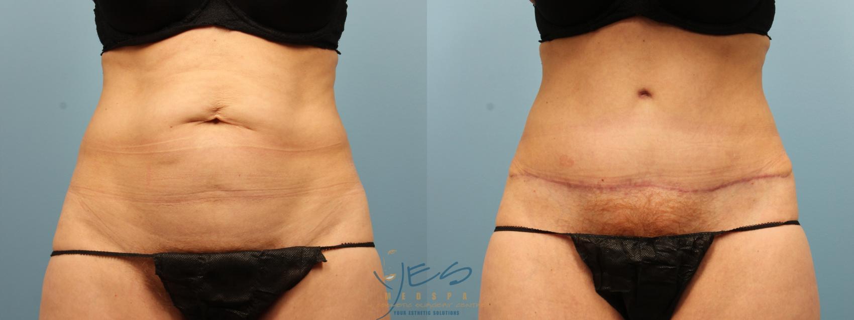Before & After Liposuction Case 276 Front View in Vancouver, BC