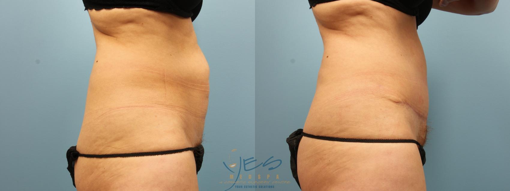 Before & After Tummy Tuck Case 276 Right Side View in Vancouver, BC