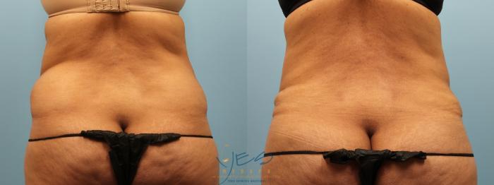 Before & After Liposuction Case 277 Back View in Vancouver, BC