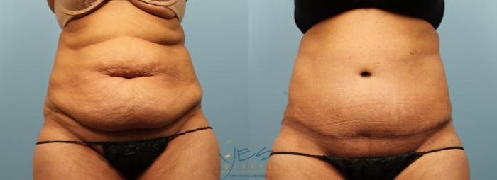 Before & After Liposuction Case 277 Front View in Vancouver, BC