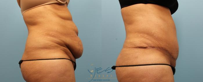 Before & After Tummy Tuck Case 277 Right Side View in Vancouver, BC
