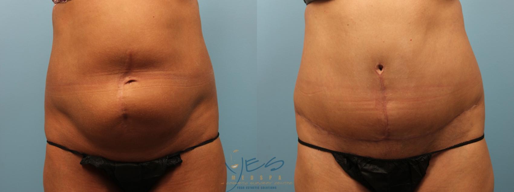 Before & After Tummy Tuck Case 283 Front View in Vancouver, BC
