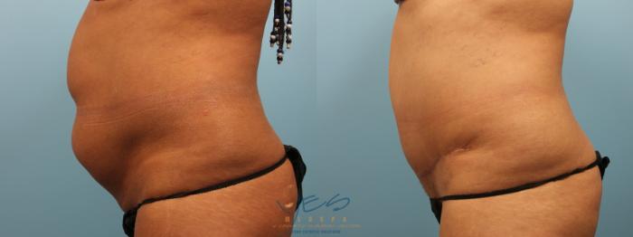 Before & After Tummy Tuck Case 283 Left Side View in Vancouver, BC