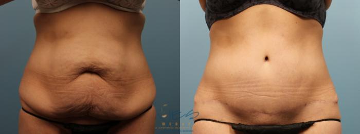 Before & After Tummy Tuck Case 324 Front View in Vancouver, BC