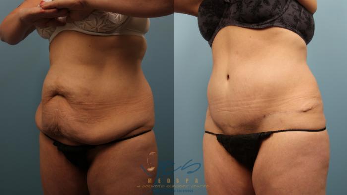Before & After Tummy Tuck Case 324 Left Oblique View in Vancouver, BC