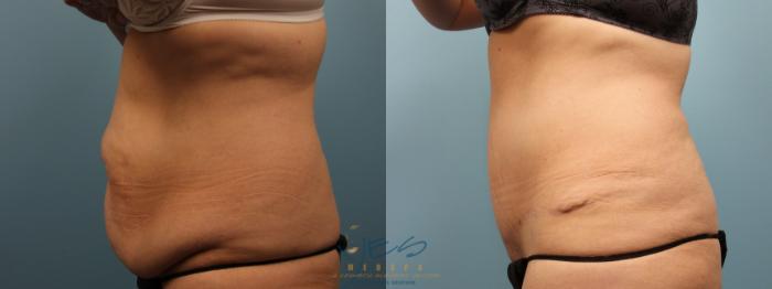 Before & After Tummy Tuck Case 324 Left Side View in Vancouver, BC