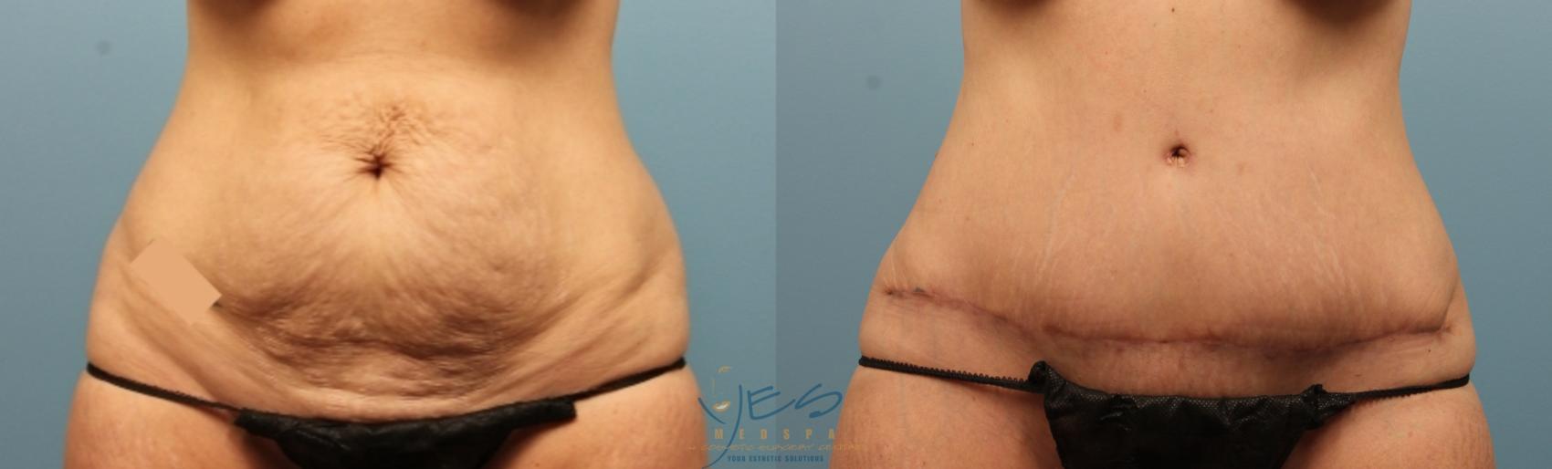 Before & After Liposuction Case 354 Front View in Vancouver, BC