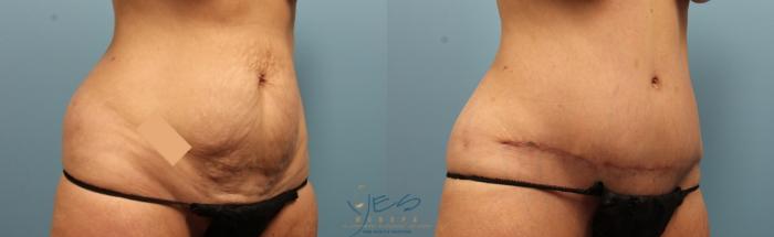 Before & After Tummy Tuck Case 354 Right Oblique View in Vancouver, BC