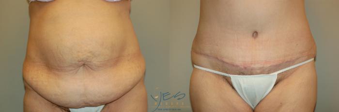 Before & After Tummy Tuck Case 36 Front View in Vancouver, BC