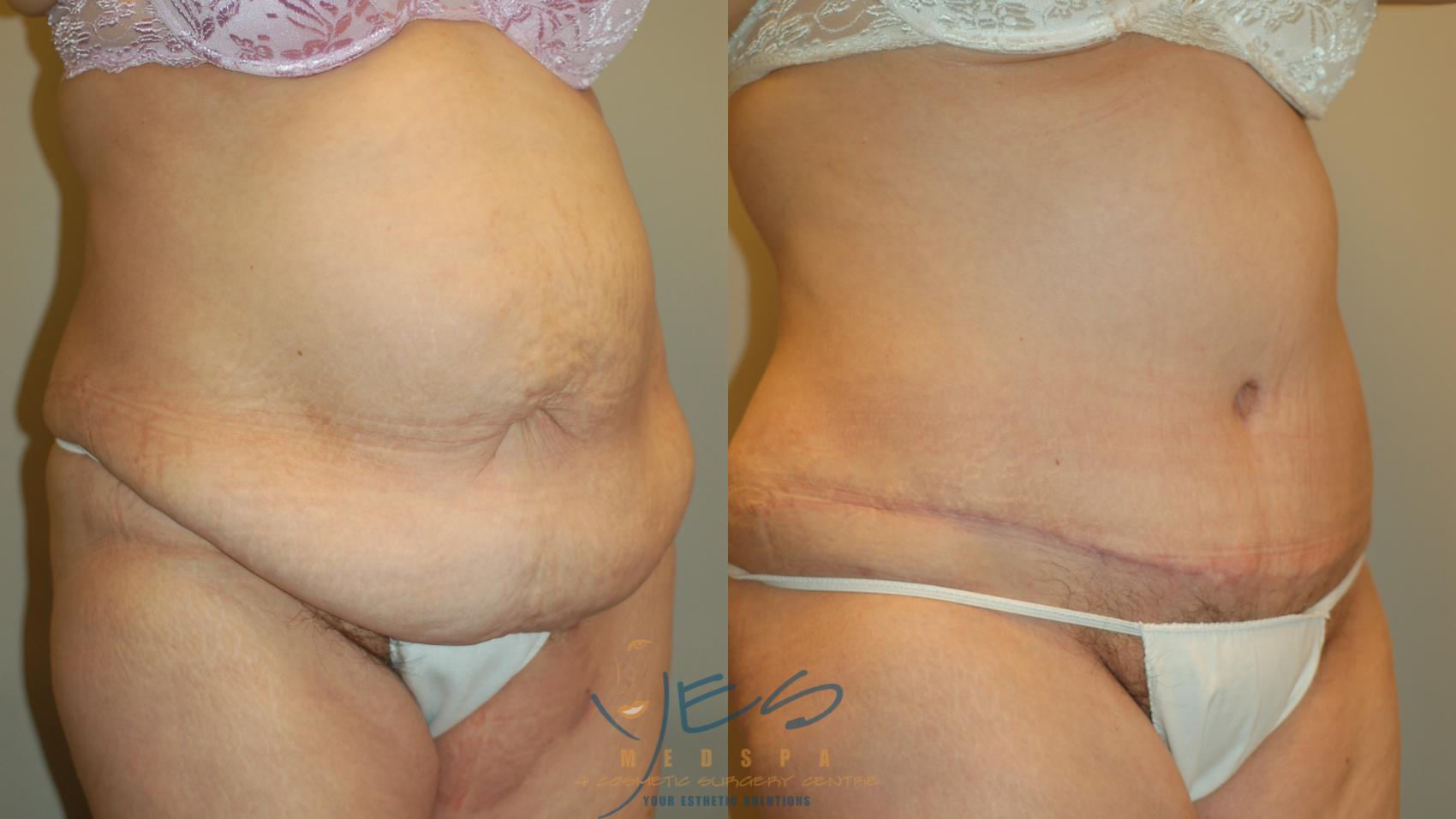 Before & After Tummy Tuck Case 36 Right Oblique View in Vancouver, BC